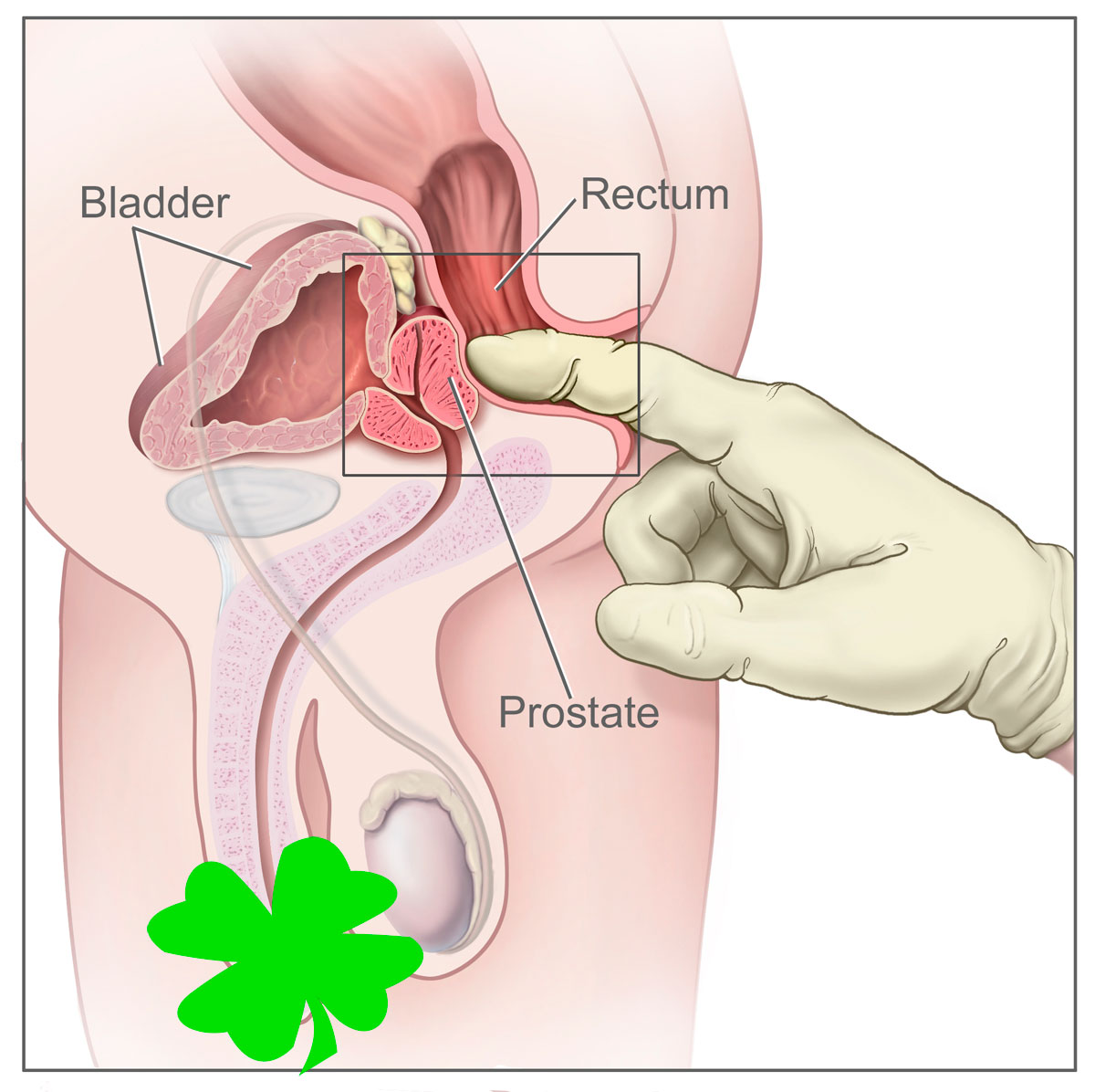 Prostate.jpg