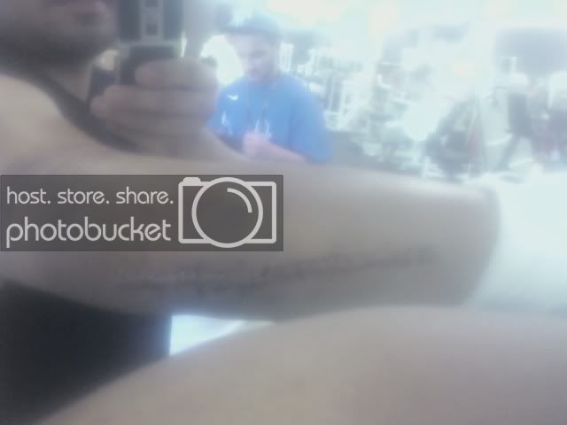 Willsbrokeelbow.jpg