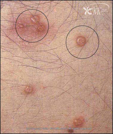 Molluscum_Contagiosum550_ab.jpg