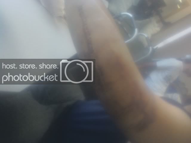 Willsbrokeelbow2.jpg