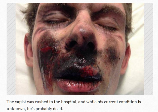 Injured-vaper-E-cigarette-explosion.jpg