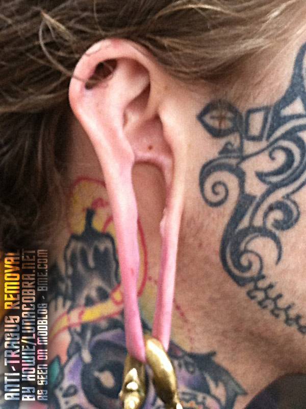 antitragus-removal-by-howie-1.jpg