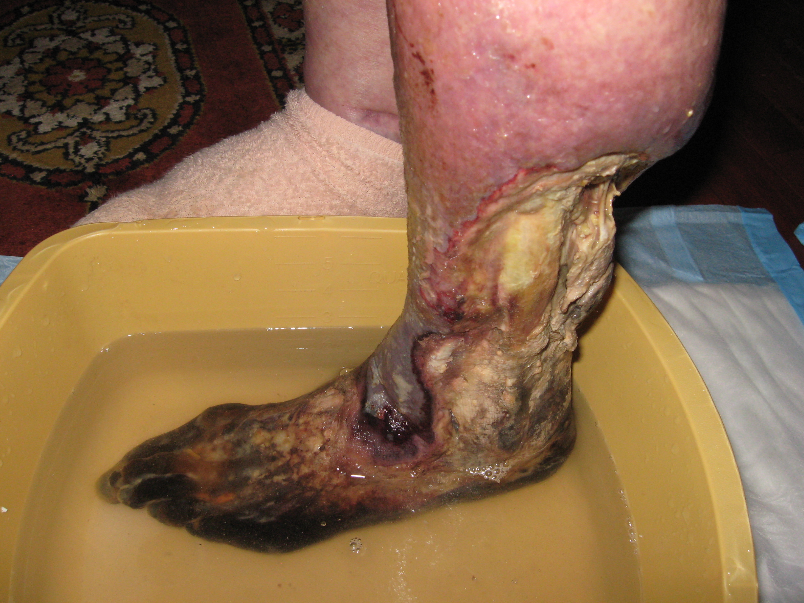 Dry_Gangrene_with_dead_toes_and_visible_bone.JPG
