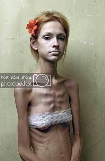 anorexic.jpg