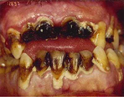 meth-teeth-4.jpg