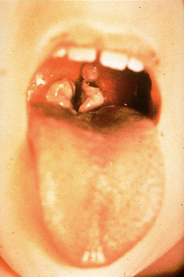 diphtheria.jpg